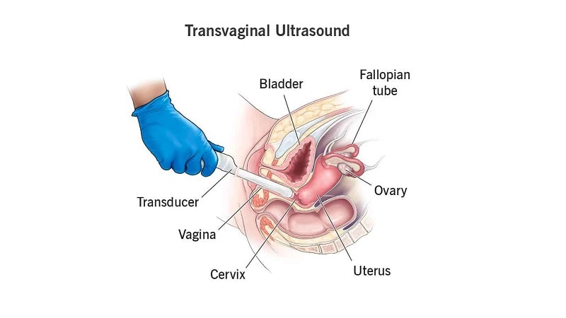 Vaginal-ultrasound